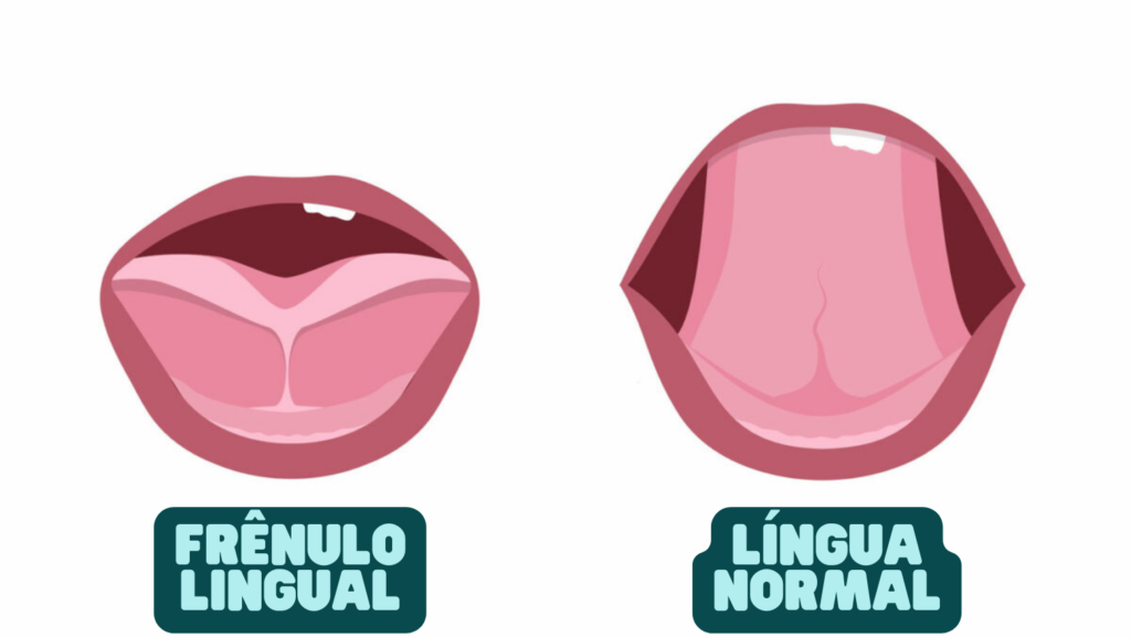 Frênulo Lingual e Língua Normal